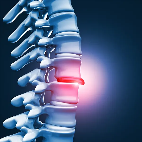 Disc Injury Treatment Near Me in Southwest Denver, CO. Chiropractor for Disc Injury Pain Relief.